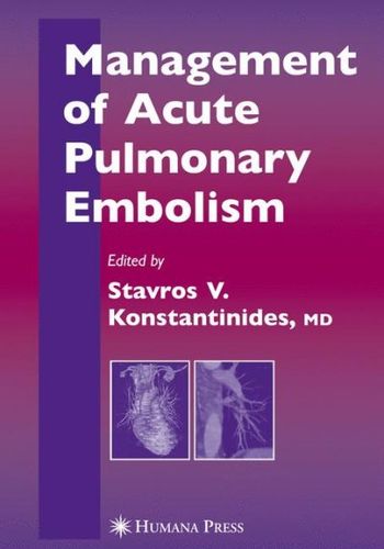 Management of Accute Pulmonary Embolismmanagement 