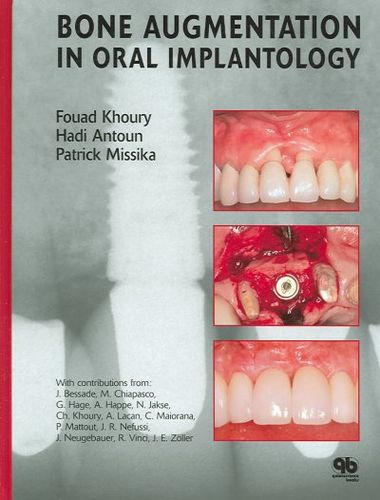 Bone Augmentation in Oral Implantologybone 