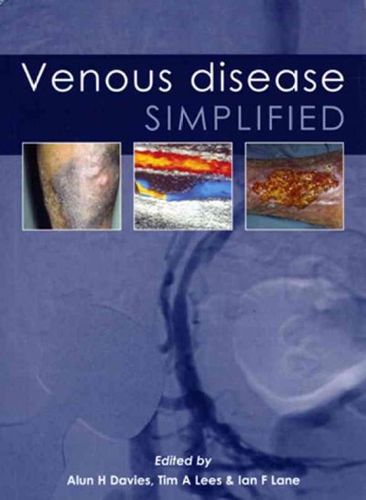 Venous Disease Simplifiedvenous 
