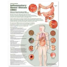 Understanding Inflammatory Bowel Disease (Ibd) Anatomical Chartunderstanding 