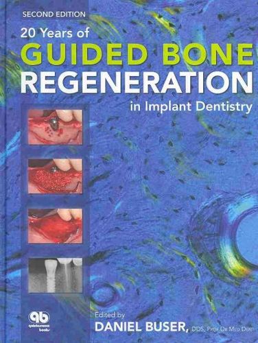 20 Years of Guided Bone Regeneration in Implant Dentistryyears 