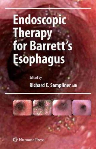 Endoscopic Therapy for Barrett's Esophagusendoscopic 