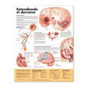 Entendiendo Que Es Un Derrame/Understanding Stroke Anatomical Chartentendiendo 