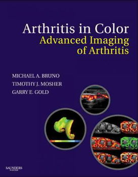 Arthritis in Colorarthritis 