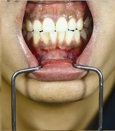 Orringer Lip Wider, Small / Child Size